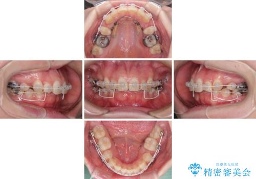著しい八重歯を短期間で改善 ワイヤー装置による抜歯矯正の治療中