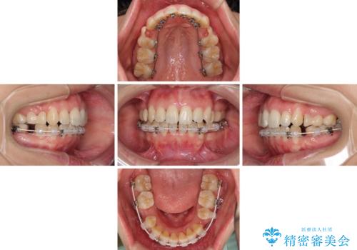 Eラインを改善したい ハーフリンガルによる抜歯矯正の治療中