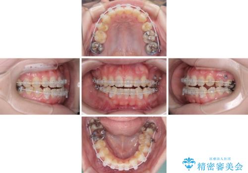 八重歯と前歯の欠損と骨格のズレ 目立たないワイヤー矯正の治療中