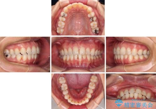 前歯の叢生をいつの間にか改善 インビザラインによる矯正治療の治療中