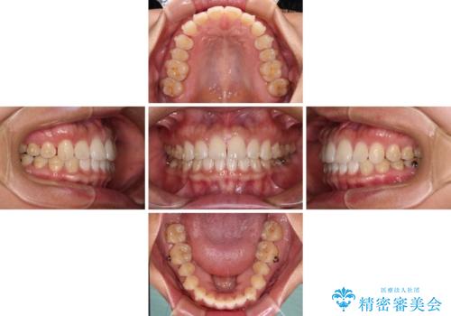 【モニター】前歯のすきっ歯をインビザラインで改善の治療中