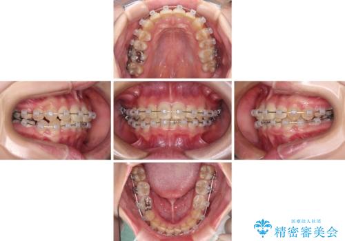 楽してクロスバイトを治したい ワイヤー装置による矯正治療の治療中