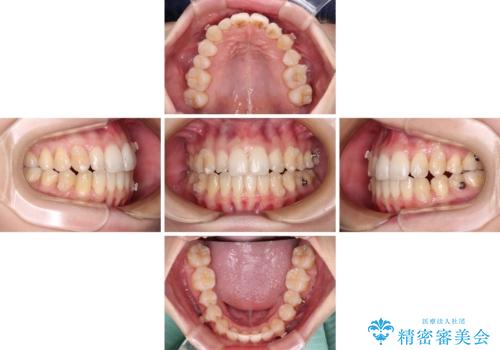 補助装置を併用したインビザラインでの八重歯の抜歯矯正の治療中