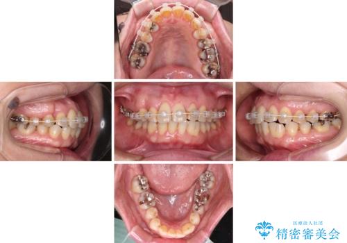 八重歯と形の悪い前歯 矯正治療とセラミック治療の治療中