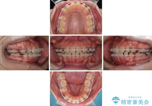 口元を引っ込めたい 目立たないワイヤー装置での抜歯矯正の治療中