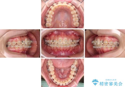 前歯のクロスバイト　目立たないワイヤー装置で速やかに矯正治療の治療中