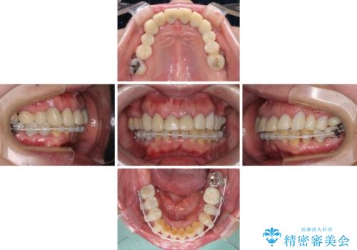 銀歯や入れ歯で汚い歯をきれいにしたい 総合歯科治療の治療中