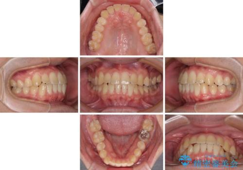 【モニター】前歯のクロスバイトと隙間を改善　インビザラインによる矯正治療の治療中