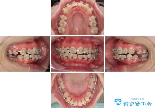 骨格的なズレをカムフラージュ 抜歯矯正で咬み合わせを改善の治療中