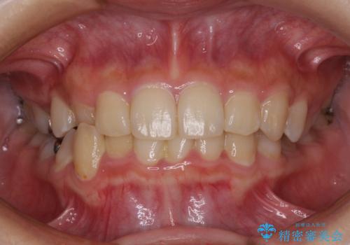 楽してクロスバイトを治したい ワイヤー装置による矯正治療の症例 治療前