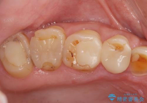 歯周外科で達成する安定したクラウン周囲の歯肉環境の治療前