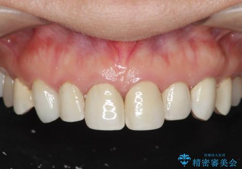 劣化してきた前歯ラミネートをジルコニアクラウンへの症例 治療前