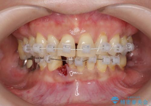 前歯のすれ違いによる歯周病を矯正治療で改善の治療中