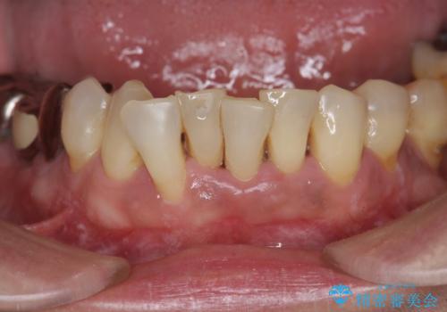 前歯のすれ違いによる歯周病を矯正治療で改善の治療前