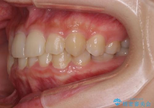 楽してクロスバイトを治したい ワイヤー装置による矯正治療の治療前