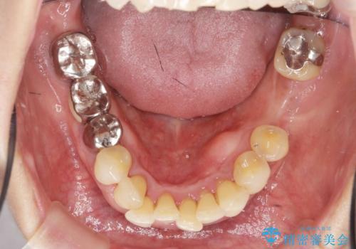 前歯のすれ違いによる歯周病を矯正治療で改善の治療前