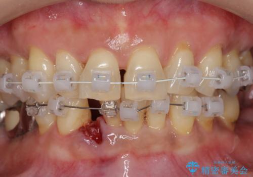 前歯のすれ違いによる歯周病を矯正治療で改善の治療中