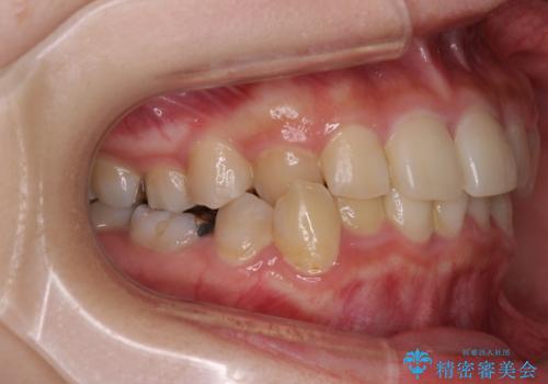 楽してクロスバイトを治したい ワイヤー装置による矯正治療の治療前