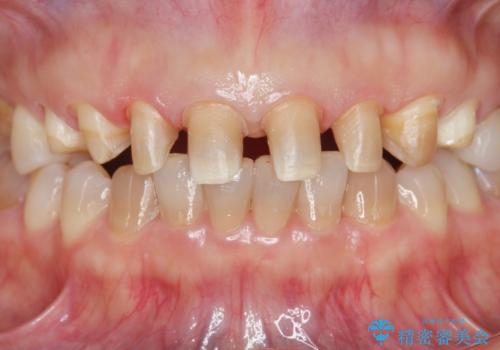 劣化してきた前歯ラミネートをジルコニアクラウンへの治療中