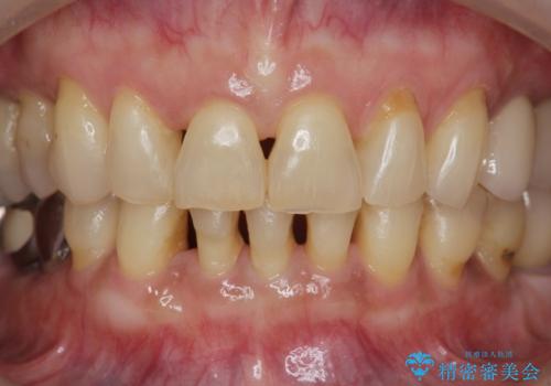 前歯のすれ違いによる歯周病を矯正治療で改善の治療後