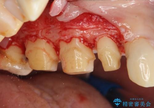 歯周外科で達成する安定したクラウン周囲の歯肉環境の治療前