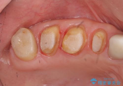 歯周外科で達成する安定したクラウン周囲の歯肉環境の治療中