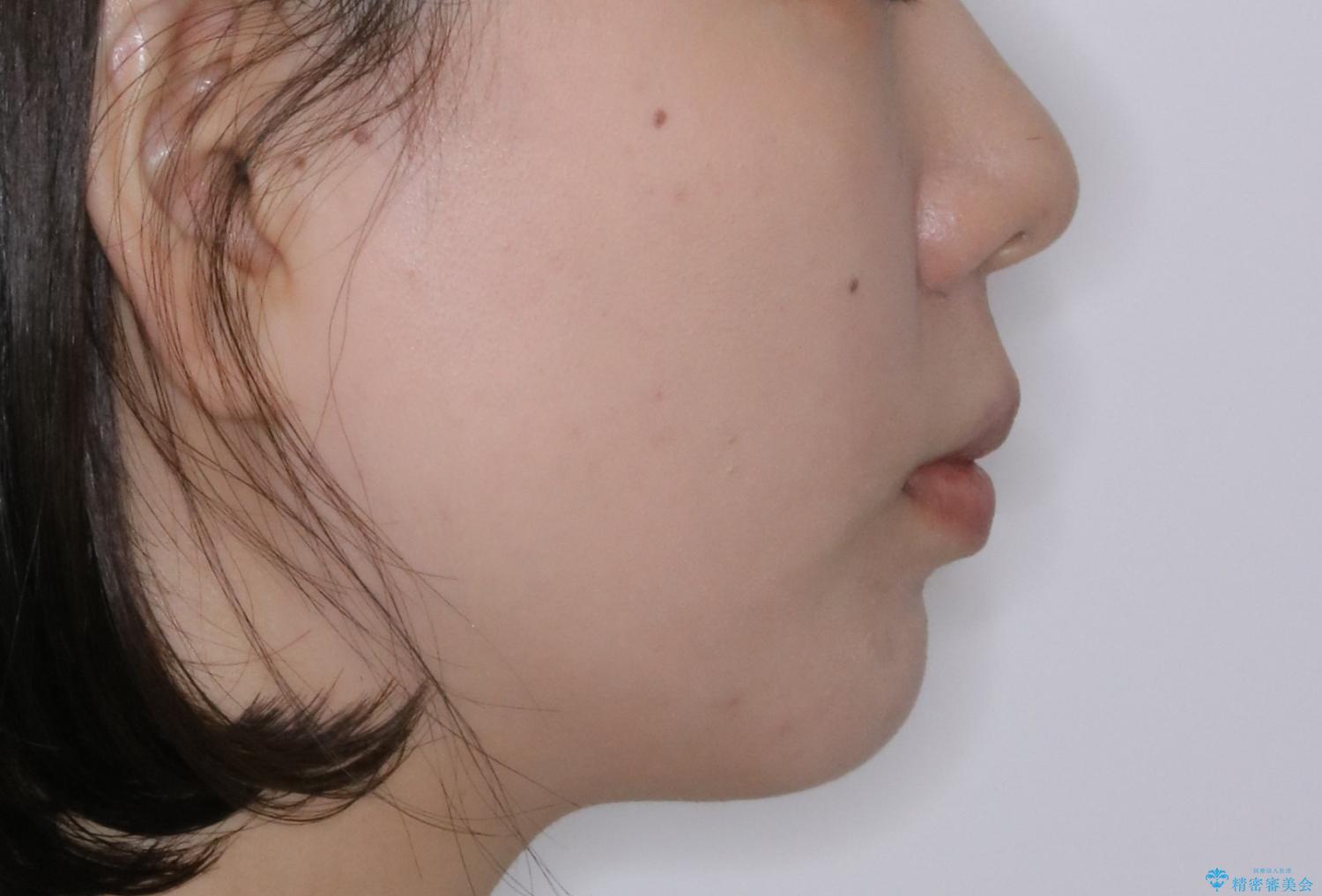 前歯の重なりは奥歯のズレが原因:まとめてインビザラインで治すの治療前(顔貌)