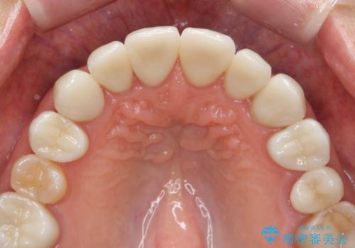 劣化してきた前歯ラミネートをジルコニアクラウンへの治療後