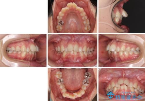デコボコで飛び出した前歯 ワイヤー装置による抜歯矯正の治療前