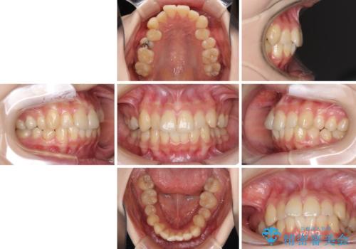 デコボコ歯列をきれいに インビザラインによる矯正治療の治療前