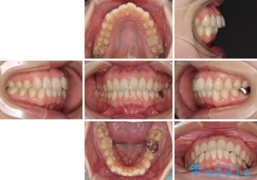 出産をしながら歯列を整える インビザラインによる矯正治療の治療前