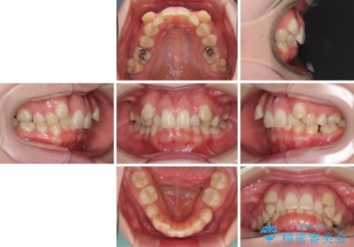 著しい八重歯を短期間で改善　ワイヤー装置による抜歯矯正の治療前