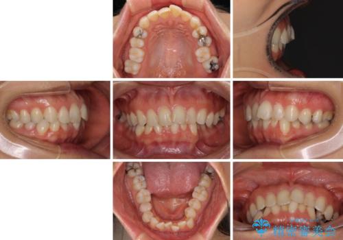 前歯の叢生をいつの間にか改善 インビザラインによる矯正治療の治療前
