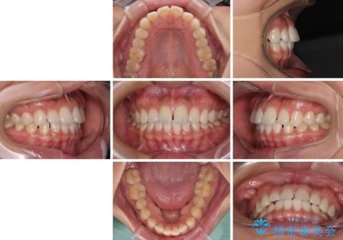 【モニター】前歯のすきっ歯をインビザラインで改善の治療前