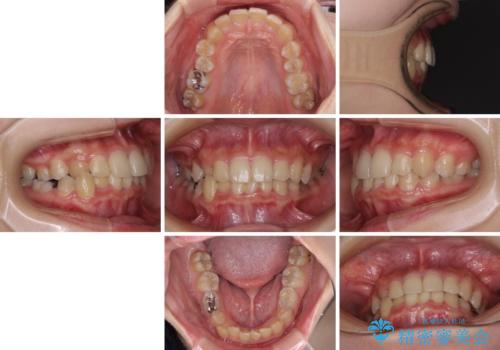 楽してクロスバイトを治したい ワイヤー装置による矯正治療の治療前