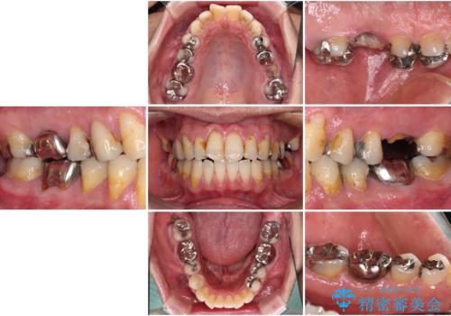欠損と痛み 奥歯のむし歯治療の治療前