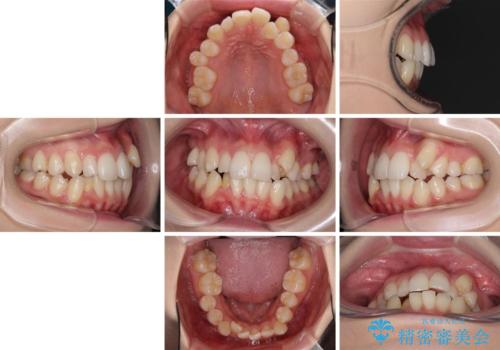 補助装置を併用したインビザラインでの八重歯の抜歯矯正の治療前