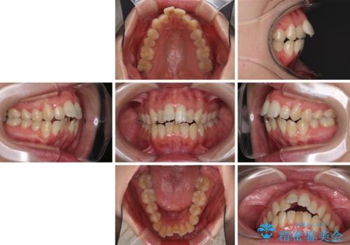 Eラインを改善したい ハーフリンガルによる抜歯矯正の治療前