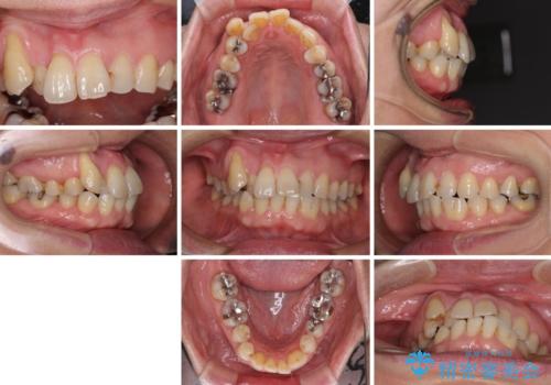 八重歯と形の悪い前歯 矯正治療とセラミック治療の治療前
