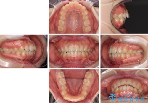口元を引っ込めたい 目立たないワイヤー装置での抜歯矯正の治療前