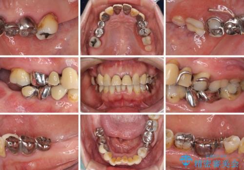 銀歯や入れ歯で汚い歯をきれいにしたい 総合歯科治療の治療前
