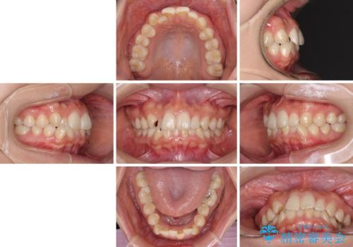 前歯のクロスバイト 目立たないワイヤー装置で速やかに矯正治療の治療前