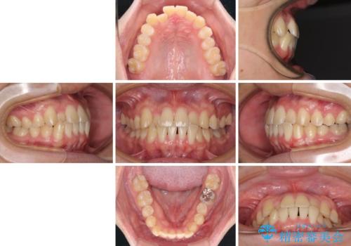 【モニター】前歯のクロスバイトと隙間を改善 インビザラインによる矯正治療の治療前