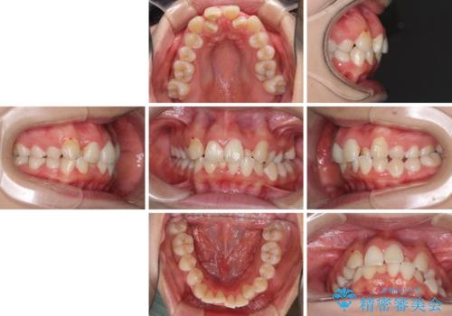 骨格的なズレをカムフラージュ　抜歯矯正で咬み合わせを改善の治療前