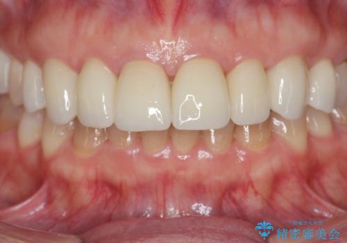 劣化してきた前歯ラミネートをジルコニアクラウンへの治療後
