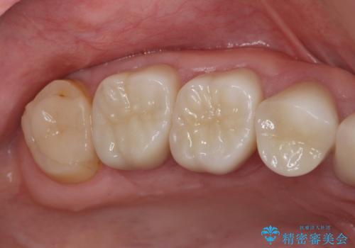 歯周外科で達成する安定したクラウン周囲の歯肉環境の治療後