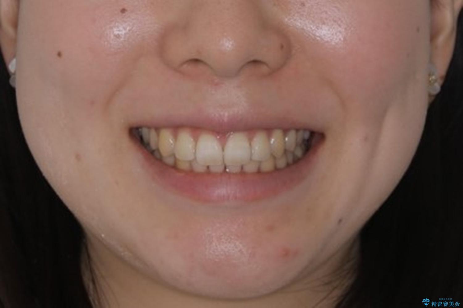 前歯の重なりは奥歯のズレが原因:まとめてインビザラインで治すの治療後（顔貌）