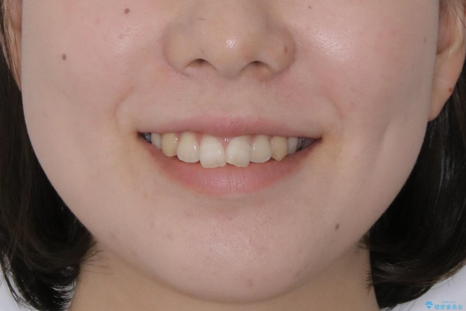 前歯の重なりは奥歯のズレが原因:まとめてインビザラインで治すの治療前（顔貌）