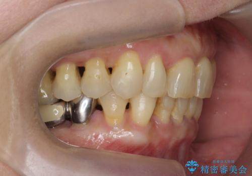 前歯のすれ違いによる歯周病を矯正治療で改善の治療後