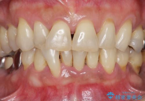 前歯のすれ違いによる歯周病を矯正治療で改善の治療前